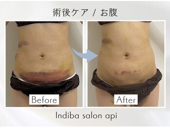 アピ(api)/症例写真【インディバ】