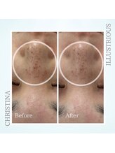 シャルムパリス(charme paris)/高濃度のビタミンＣ☆１回の変化