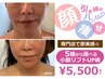 小顔人気NO1【小顔美顔】5種から選べる最先端小顔リフトアップ&肌管理¥5500