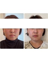 ミモザ 佐野(mimosa)/20代とにかく小顔に