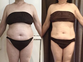 美容整体 ウェリナ 蟹江院/.【ダイエットbefore→after】