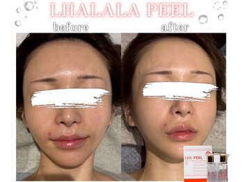 メイリリー 新宿(Meilily)/韓国肌管理☆ララピール