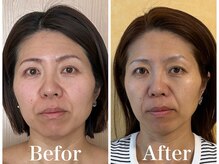 ブランカ(BLANCA)の雰囲気(むくみ、エラ張り、左右差、たるみ改善。 小顔セラピア)