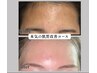 【本気の肌質改善】酵素ハーブピーリング6回コース66,000円→55,000円