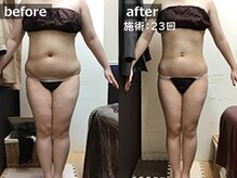 セレブリボーン 大阪ボーテ/サーモシェイプDEEP