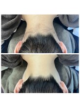 ミース 長野店/うなじ矯正◆ビフォーアフター