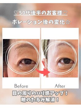 エステサロン 凛/まぶたのしわ&たるみがっ!!