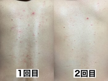 エモーショナル 姫路(Emotional)/背中ハーブピーリング2回の効果