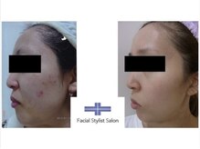 フェイシャルスタイリストサロン 四谷店/ケア例(15)