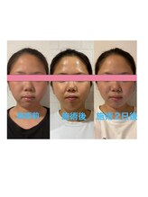 サロンドミジュ(Salon de 美jyu)/小顔・骨格矯正　K様　20代