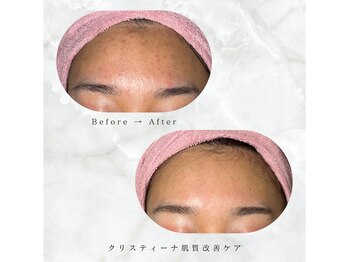 ティセラ(TISERA.)/ニキビケア/跡/シミ予防