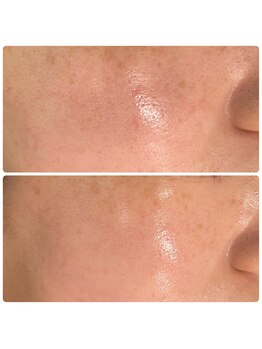 レディースシェービングサロン アール(R)/キメが整った肌へ