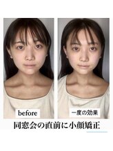 ビジュー(bijoux)/一度のビオアフ２