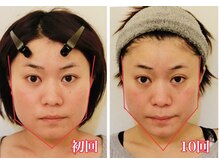 小顔22 ボルティ 赤坂支店(Bolty)/顔分析