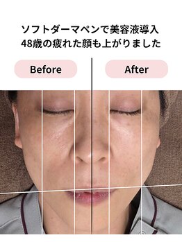 恵比寿脱毛 シーズ(She’s)/ソフトダーマ40代後半ビフォア