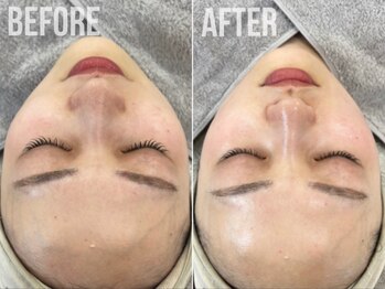 煌(kirameki)/【小顔】小顔リフトUP症例