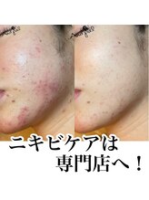 アンドピエル(AndPiel)/ニキビケアは専門店へ