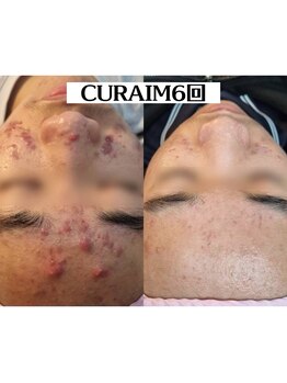 ハオン(HAON)/韓国美容/ニキビ/毛穴/大阪