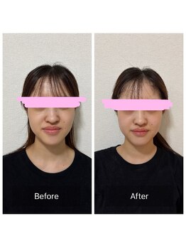 マハロ 海老名店(Mahalo)/小顔矯正専門Mahalo#20代女性