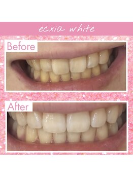 エクシアホワイトニング 仙台駅東口店/ホワイトニングビフォーアフター