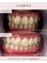 ホワイトニングショップ 福岡姪浜店/美白ホワイトニングbefore after