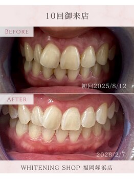ホワイトニングショップ 福岡姪浜店/美白ホワイトニングbefore after