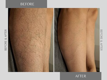 テリー(Terry)の写真/【美容男子必見★】メンズ脱毛も最近では当たり前！清潔感UPで好印象に♪脱毛デビューの方にもオススメ◎