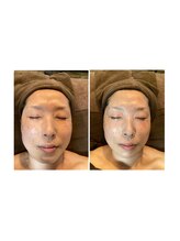 グラチア(Gratiae)/50代/たるみ改善で引き上げ小顔