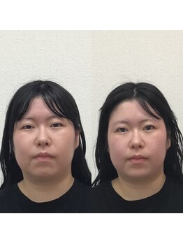 オズ六本木/六本木小顔矯正(整顔)施術1回
