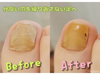 ニコルル 高崎店(Nicolulu)/分厚い爪！伸びにくい爪も！