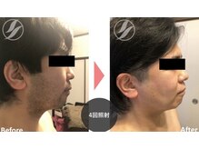 アクア カイロプラクティック アンド エステティック 豊田店(AQUA)の雰囲気（ヒゲ顔全体脱毛¥5980☆全身脱毛¥9980）