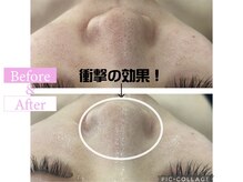 カンナムビューティー 新宿 代々木/ハーブピーリング圧倒的毛穴レス