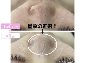 カンナムビューティー 新宿 代々木/ハーブピーリング圧倒的毛穴レス