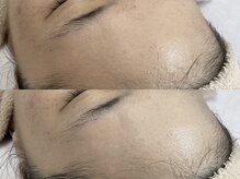 キヌ(KINU)/症例写真（くすみ）