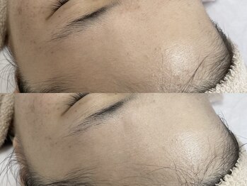 キヌ(KINU)/症例写真（くすみ）