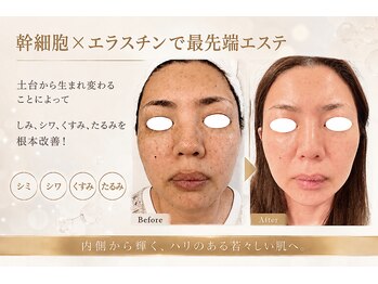 カプリ(CAPRI)の写真/話題の幹細胞×エラスチン導入フェイシャルエステ♪ダウンタイムなしで最新美容を気軽に◎