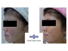 フェイシャルスタイリストサロン 四谷店/ケア例(18)