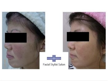 フェイシャルスタイリストサロン 四谷店/ケア例(18)