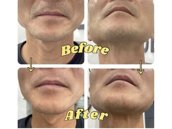 セルフメイド サンリブしみず店(SELFMADE)/ヒゲ途中経過