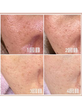 サロン ヌーク(salon Nook)/毛穴のケア/毛穴洗浄/ニキビ改善