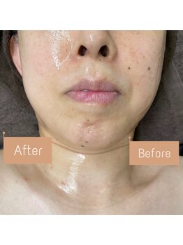 FJ/ほうれい線◆タルミ改善