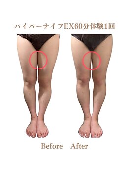 エステサロン ヴリエ 立川店/★ハイパーナイフEX★体験1回