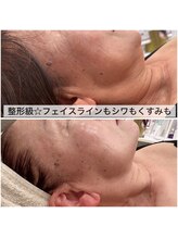 アニス/次世代サーマクールのエステ版