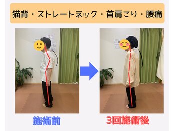 戸田はりきゅう整骨院/足指整体Before・After