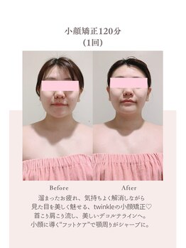 トゥインクル 麻布(twinkle)/白金高輪/シンメトリー小顔矯正