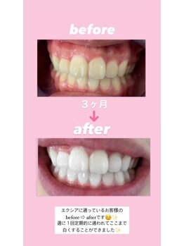 エクシアホワイトニング 札幌中島公園店/豆知識［ホワイトニング］