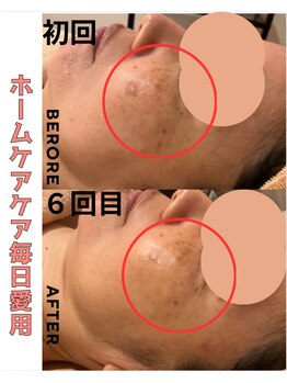 パルティノ 高崎店/５０代・シミケア・くすみ