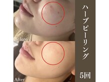 サロンドペシェ(salon de peche)/ハーブピーリング5回の変化