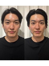 マホロバ(mahoroba)/メンズ美容鍼