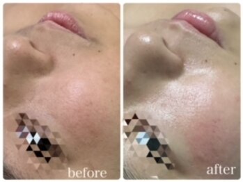 エクラニーク(Eclanique)/キッズ顔脱毛★